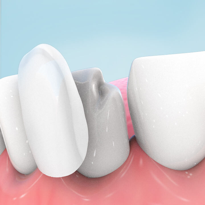 Graphic of a dental veneer